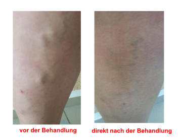 vor der Behandlung direkt nach der Behandlung