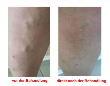 vor der Behandlung direkt nach der Behandlung